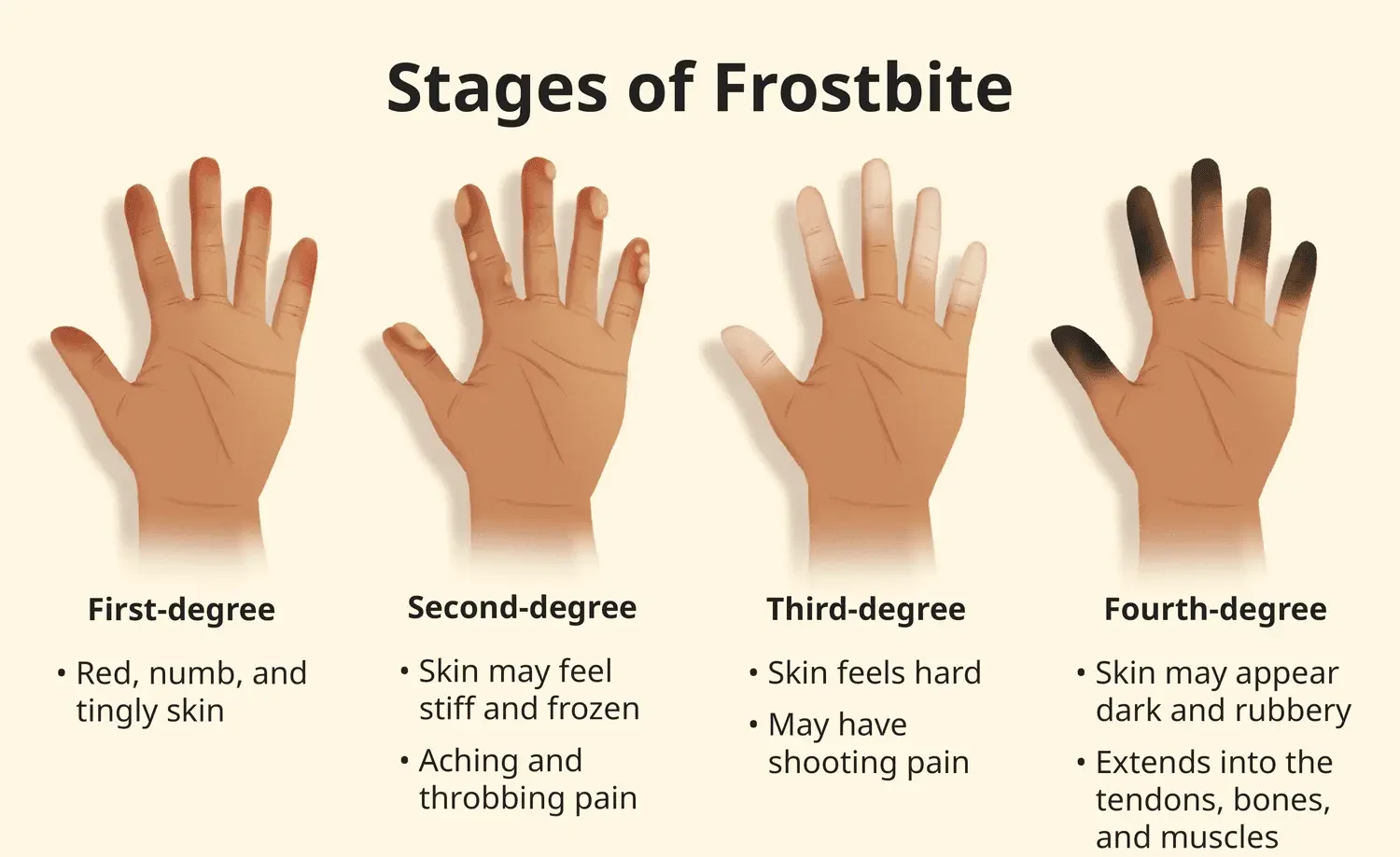 Frostbite