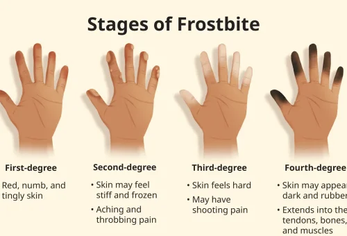 Frostbite